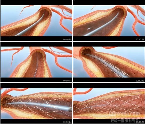 CG0398-医疗科技血管扩张动画高清动态背景素材