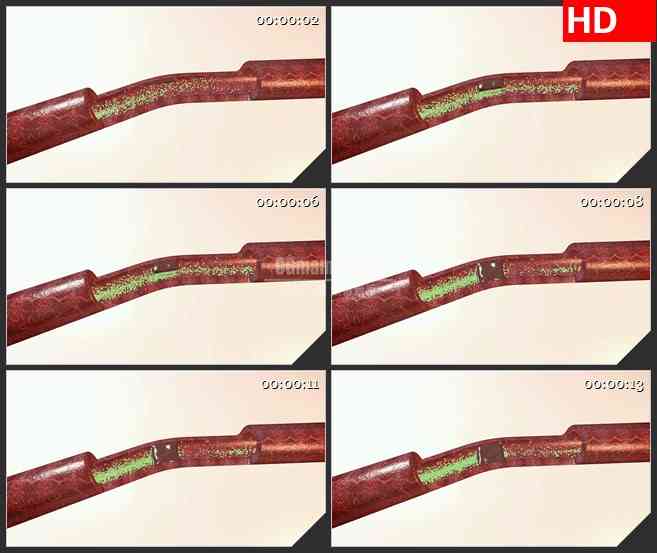 BG3096医学类 血管栓塞的形成高清led大屏视频背景素材